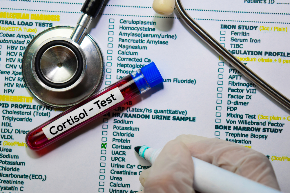 cortisol-and-weight-gain-top-view-of-test-tube-full-of-blood-labeled-with-the-word-cortisol-with-test-form-in-background
